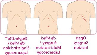 cholecystectomsingle site scars comparison